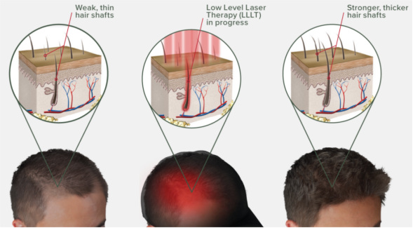 low level laser for hair growth.png